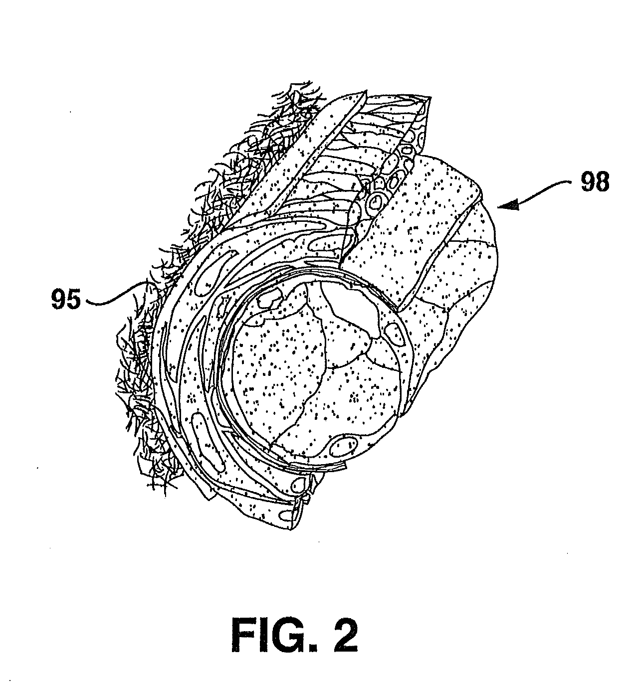 Compliant Venous Graft