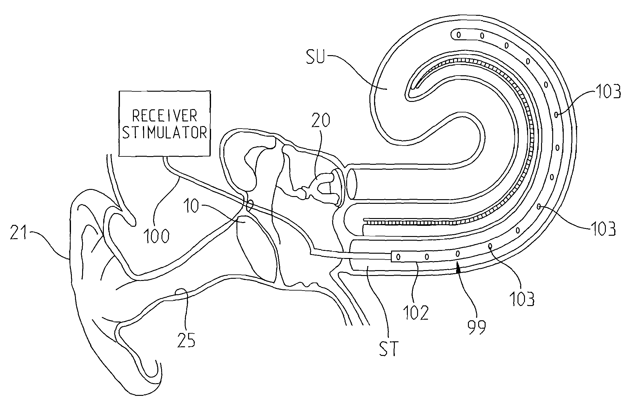 Intracochlear Nanotechnology and Perfusion Hearing Aid Device