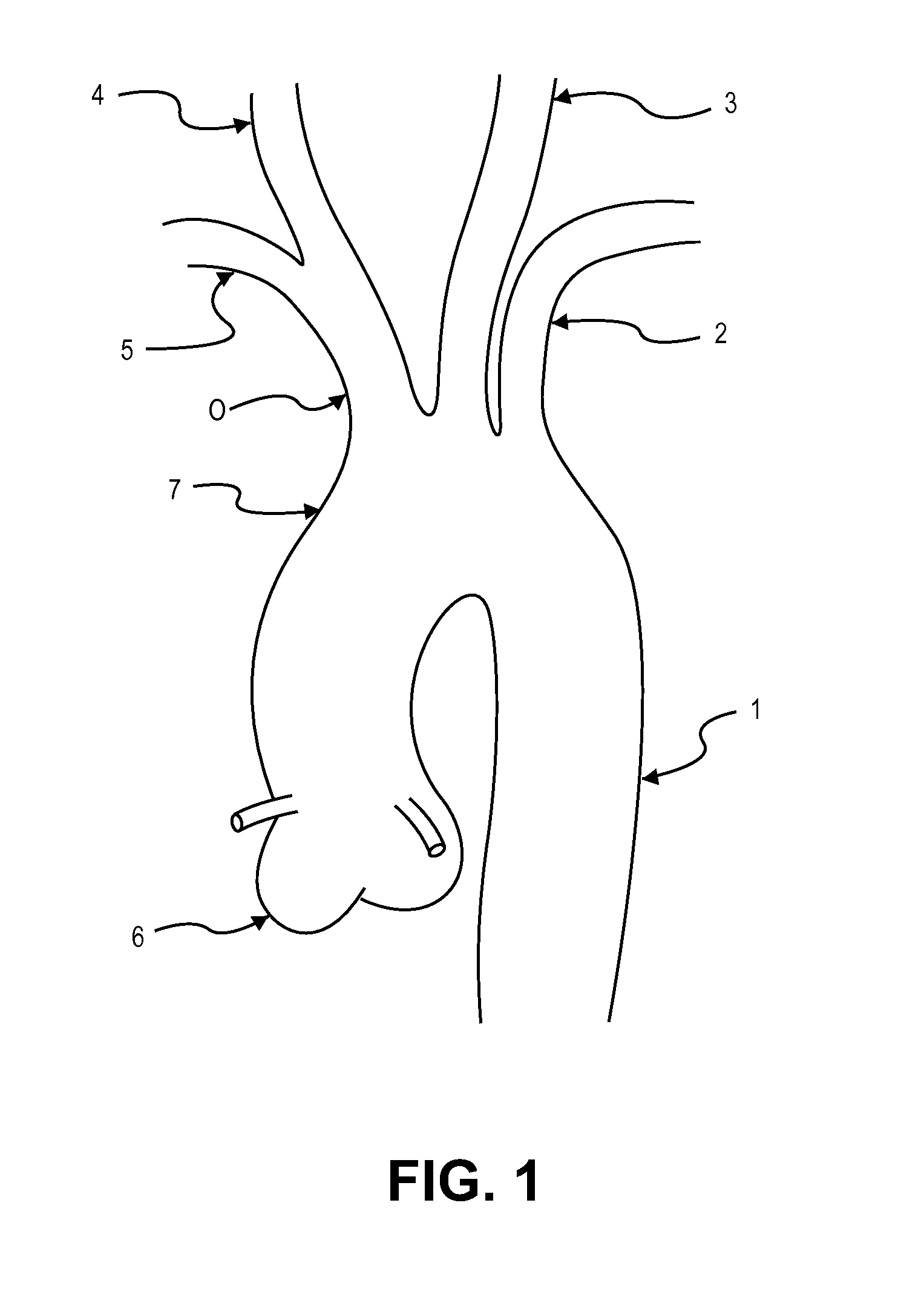 Illuminated intravascular blood filter