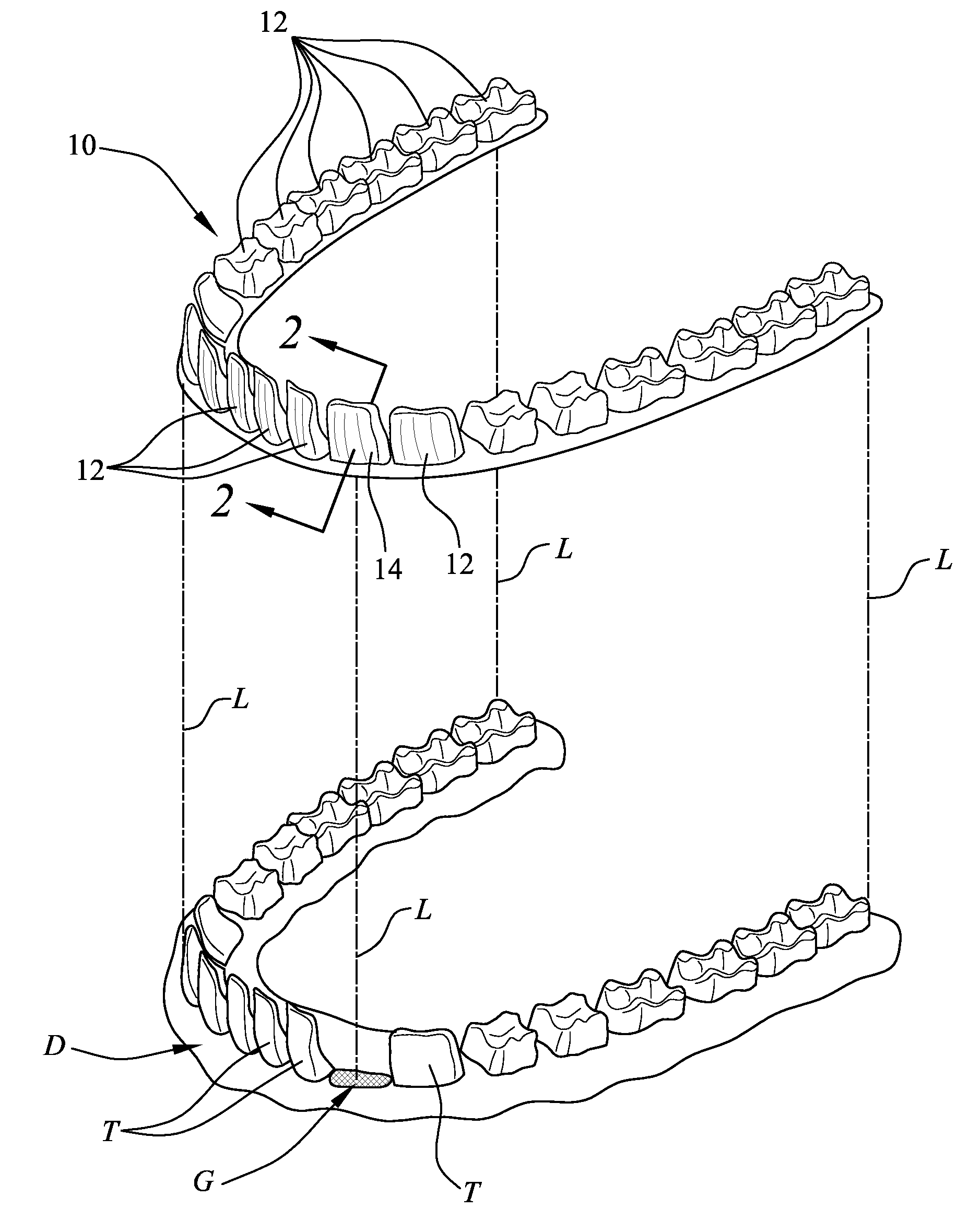 Enhancement to dental alignment device