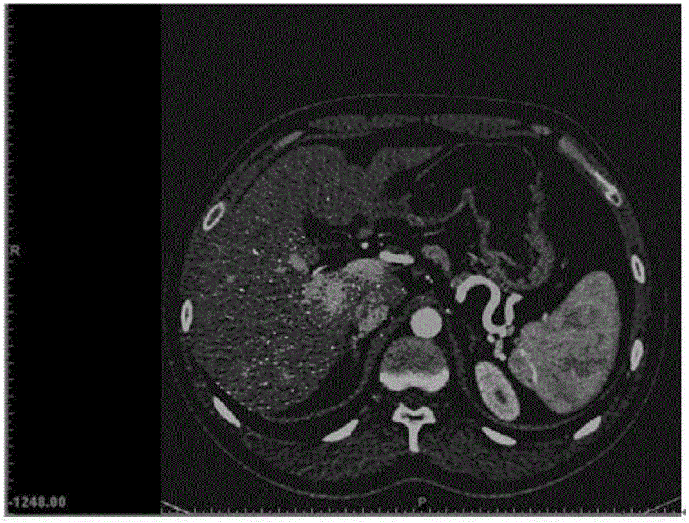 Tumor grid organ model 3D printing method