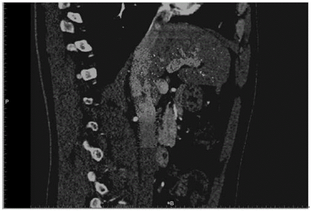 Tumor grid organ model 3D printing method