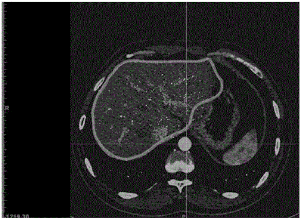 Tumor grid organ model 3D printing method