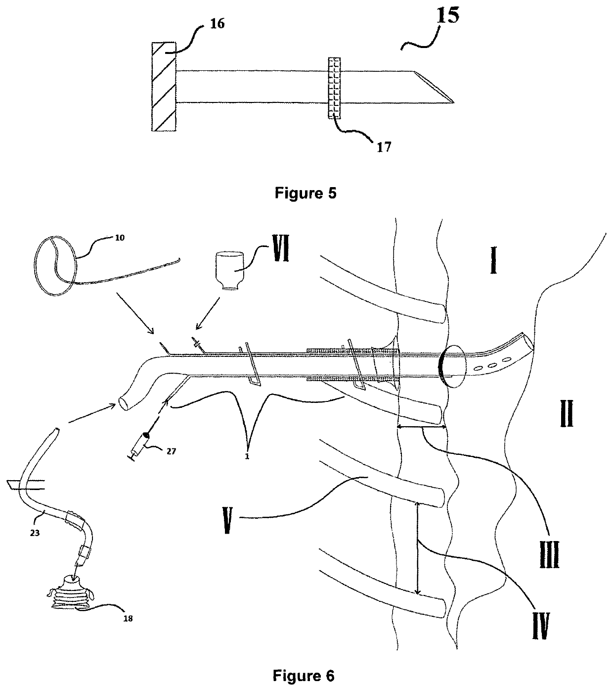 Pleural drainage set and pleural drainage method