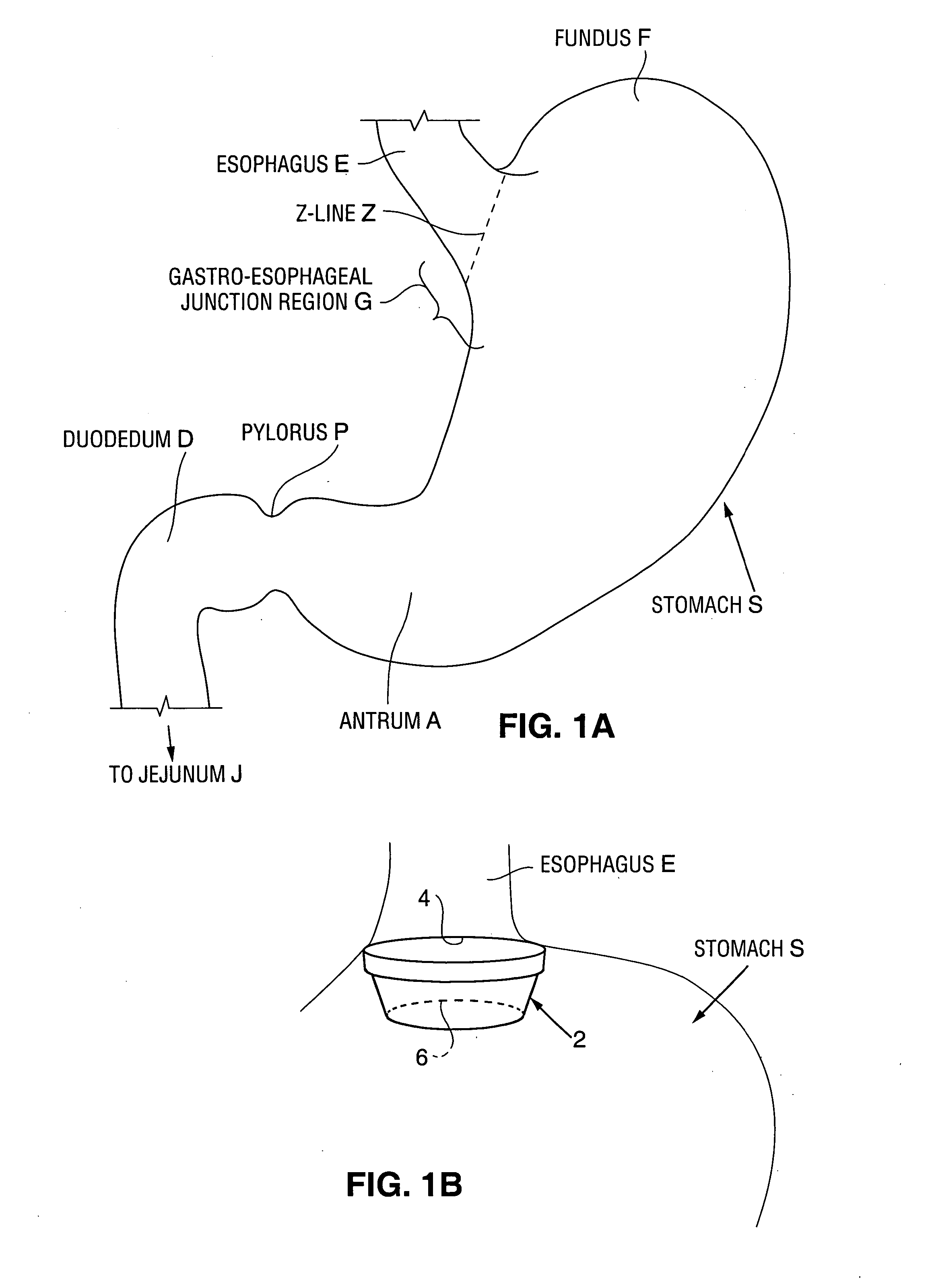 Method and apparatus for modifying the exit orifice of a satiation pouch