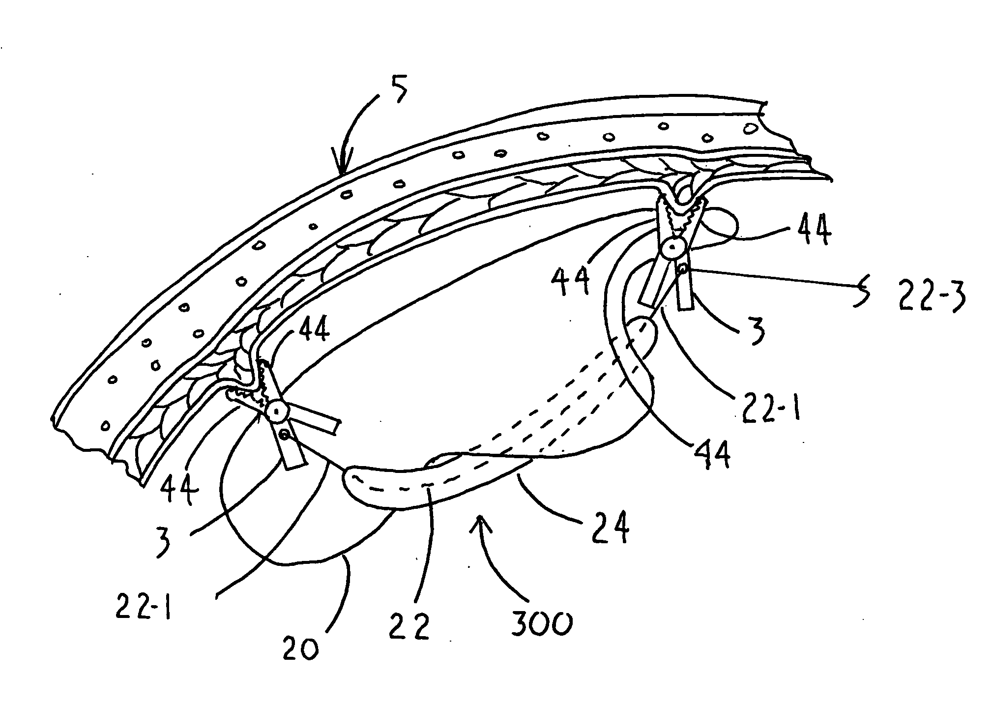 Linear tension internal organ supports and method for using the same