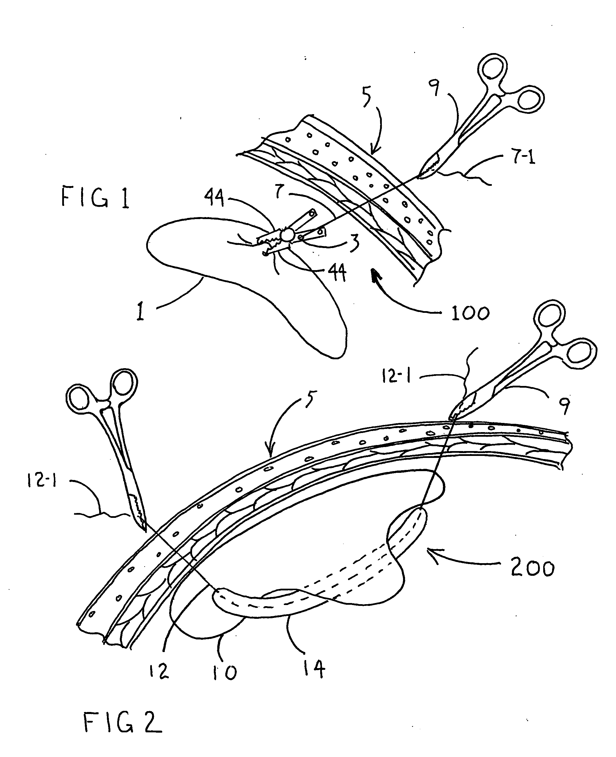 Linear tension internal organ supports and method for using the same