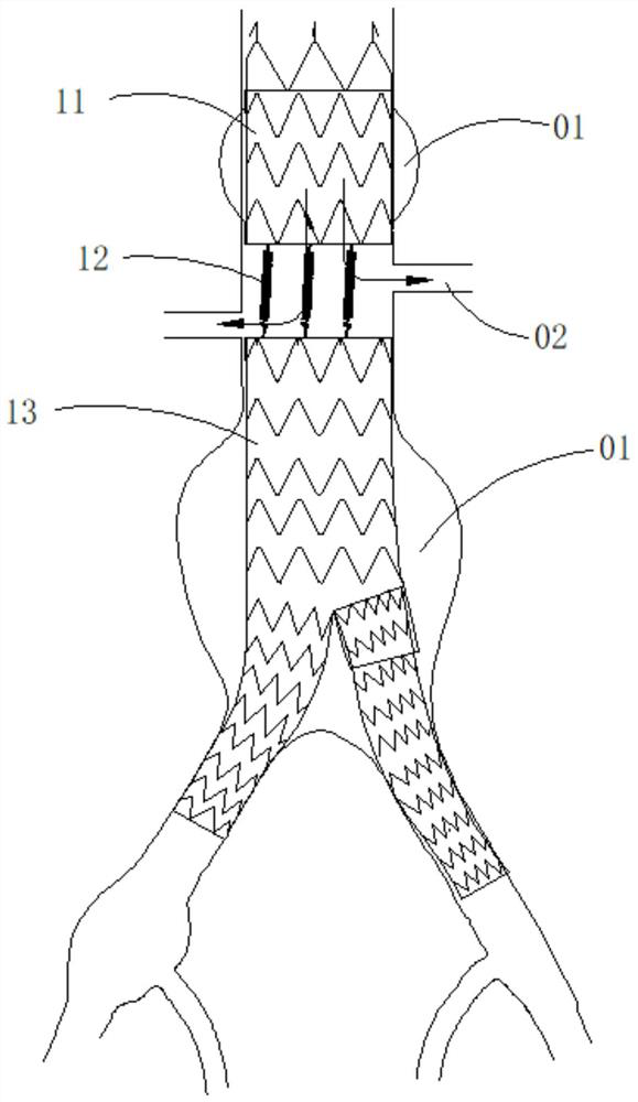 stent graft