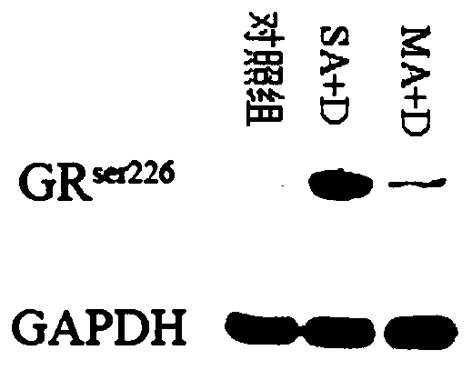 Application of GAS5 (growth arrest specific 5) in diagnosis of severe asthma