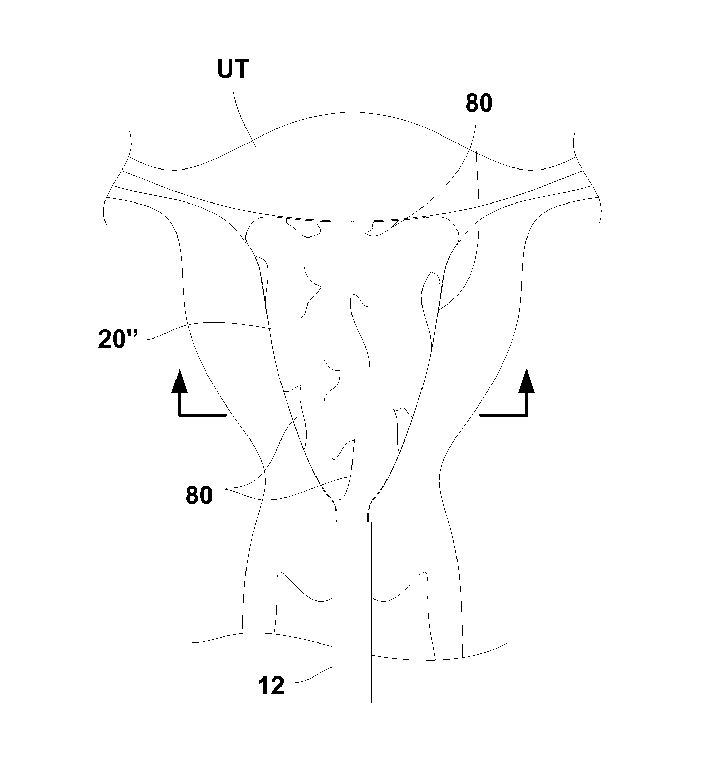 Liner for cyrogenic treatment systems