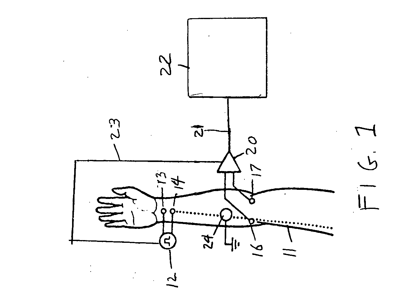 Method and apparatus for stimulus artifact suppression