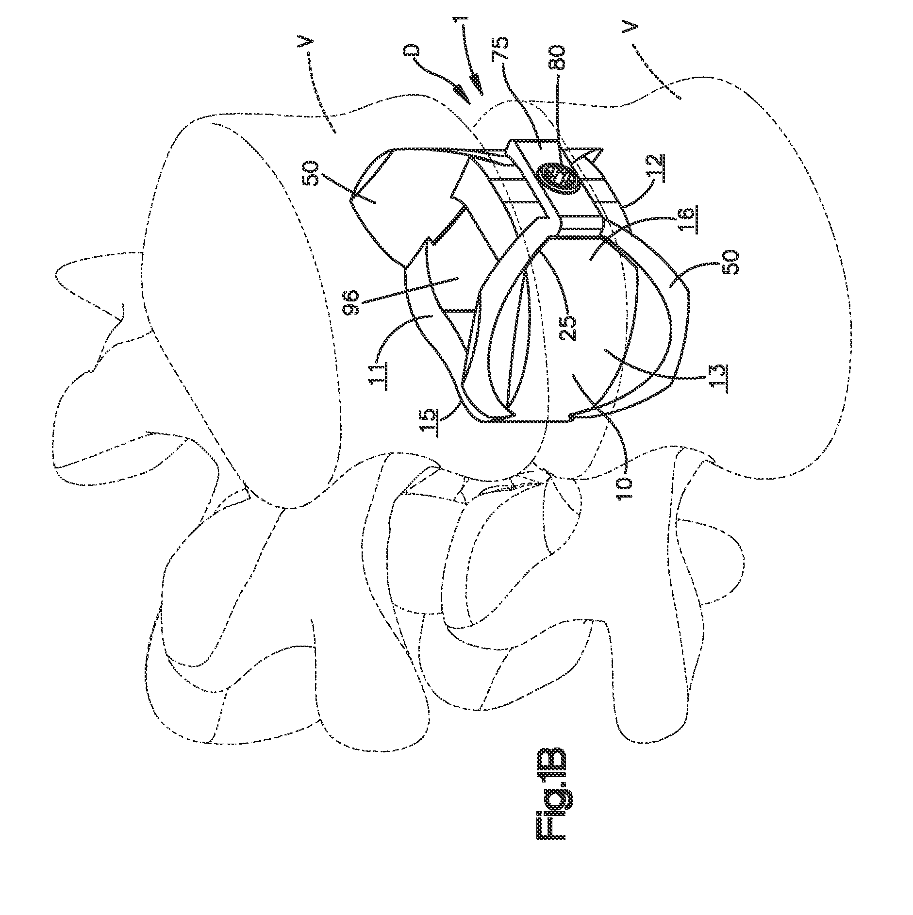 Intervertebral implant with blades for connecting to adjacent vertebral bodies