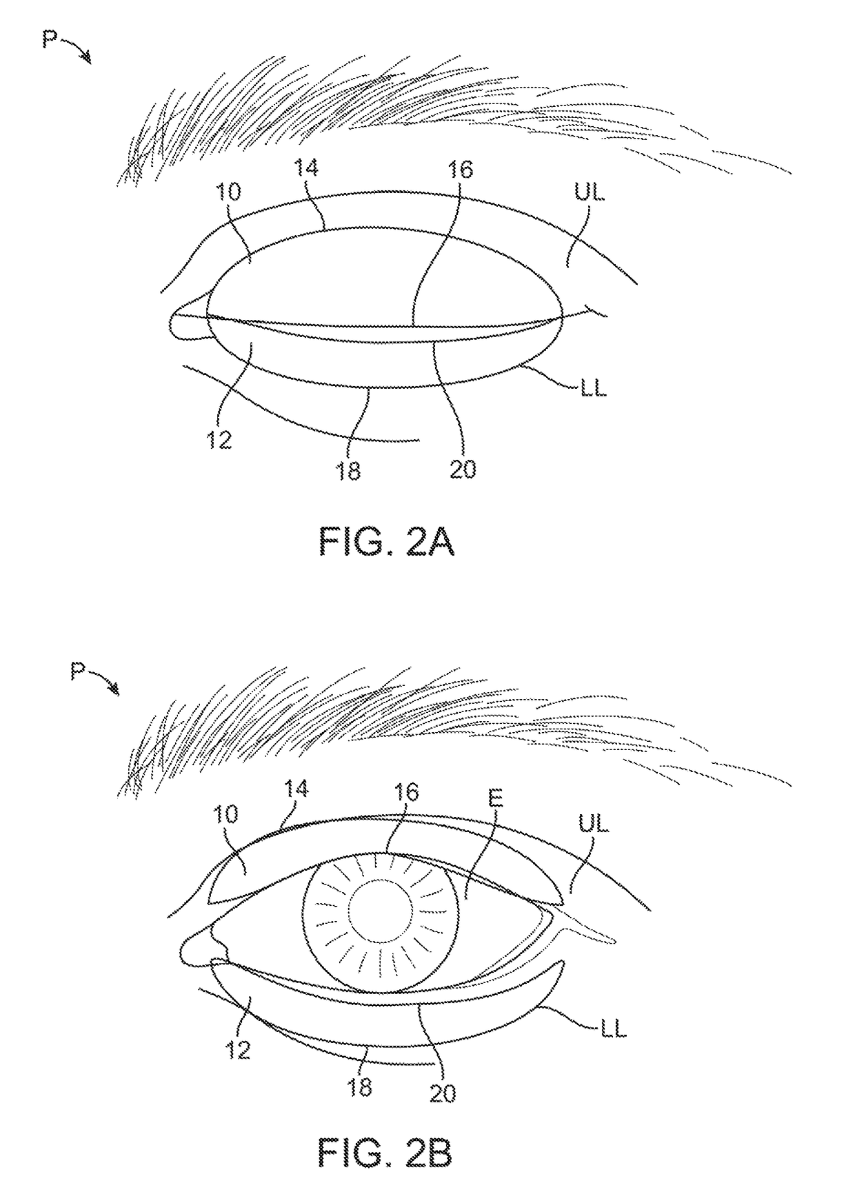 Dry eye treatment apparatus and methods