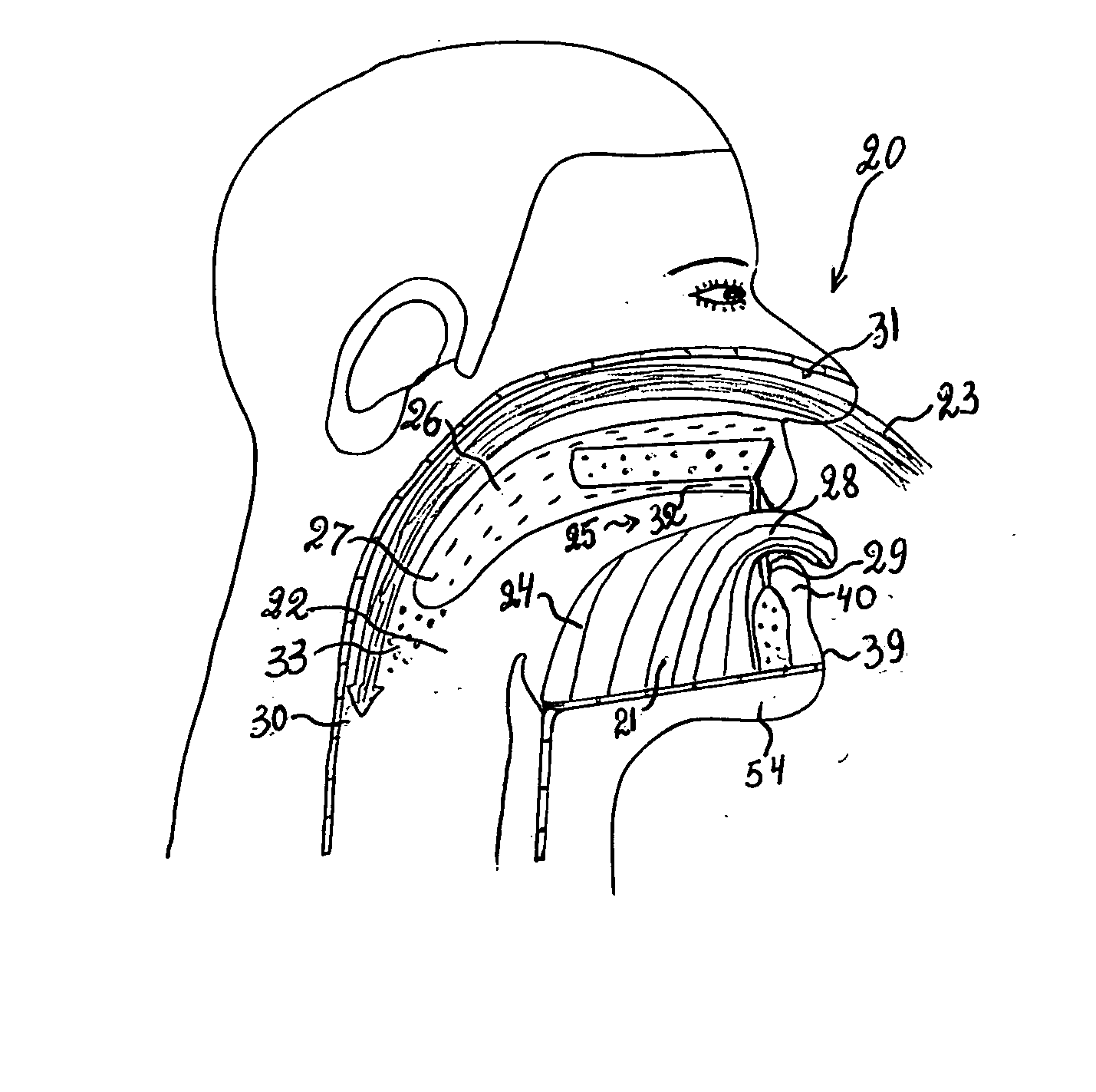 Device for the treatment of snoring and obstructive sleep apnea