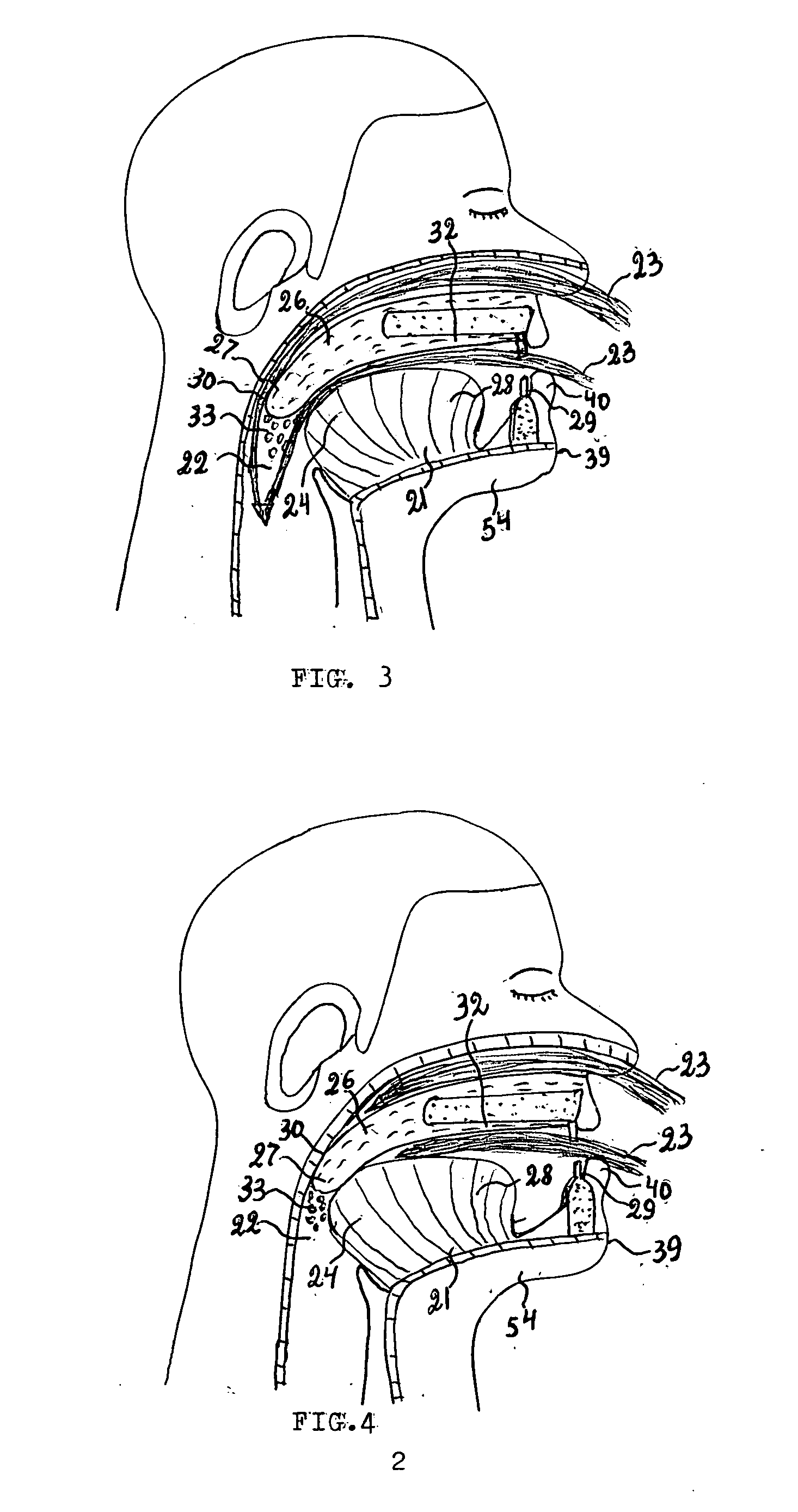 Device for the treatment of snoring and obstructive sleep apnea