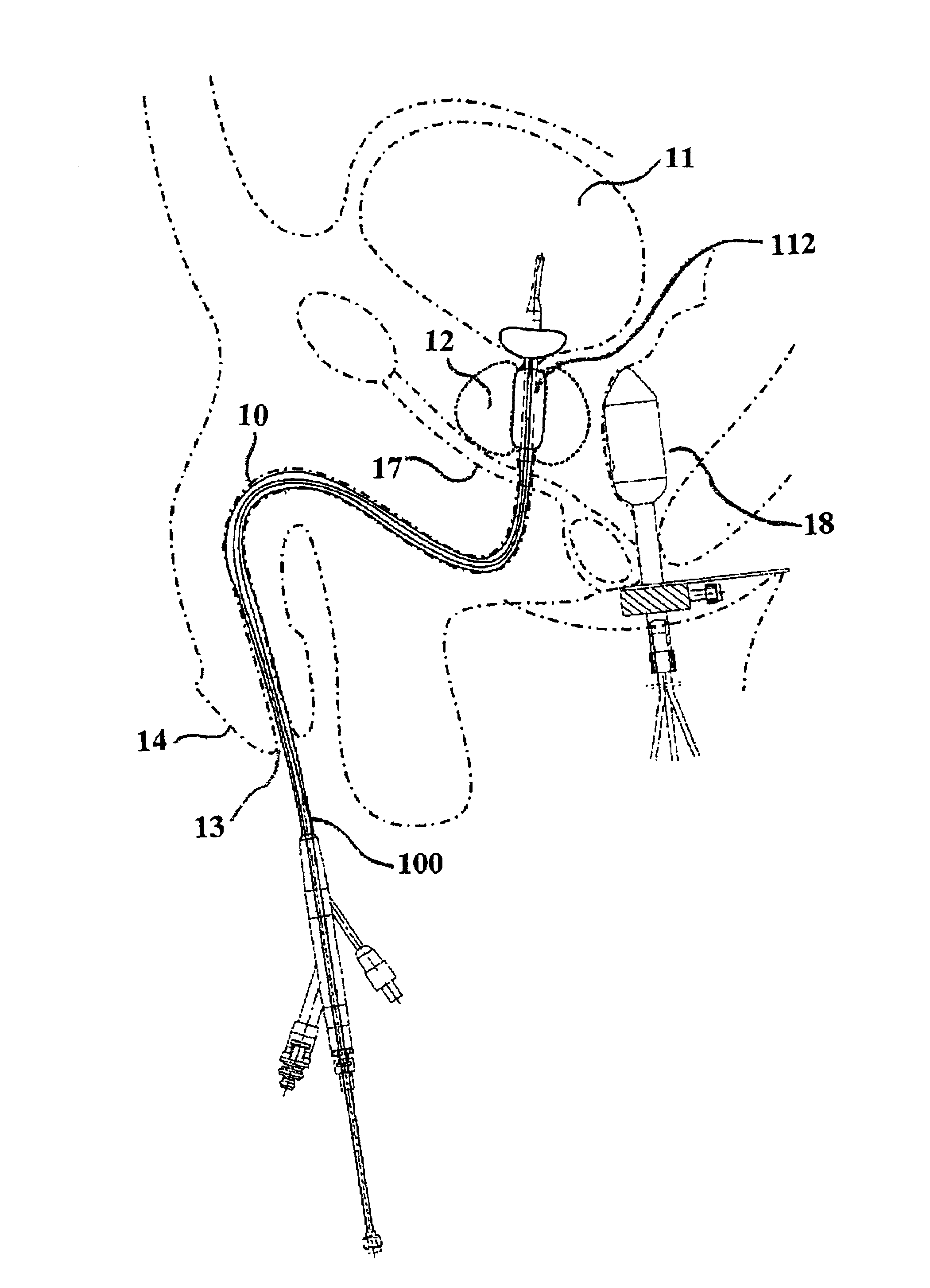 Device and method for treatment of tissue adjacent a bodily conduit by thermocompression