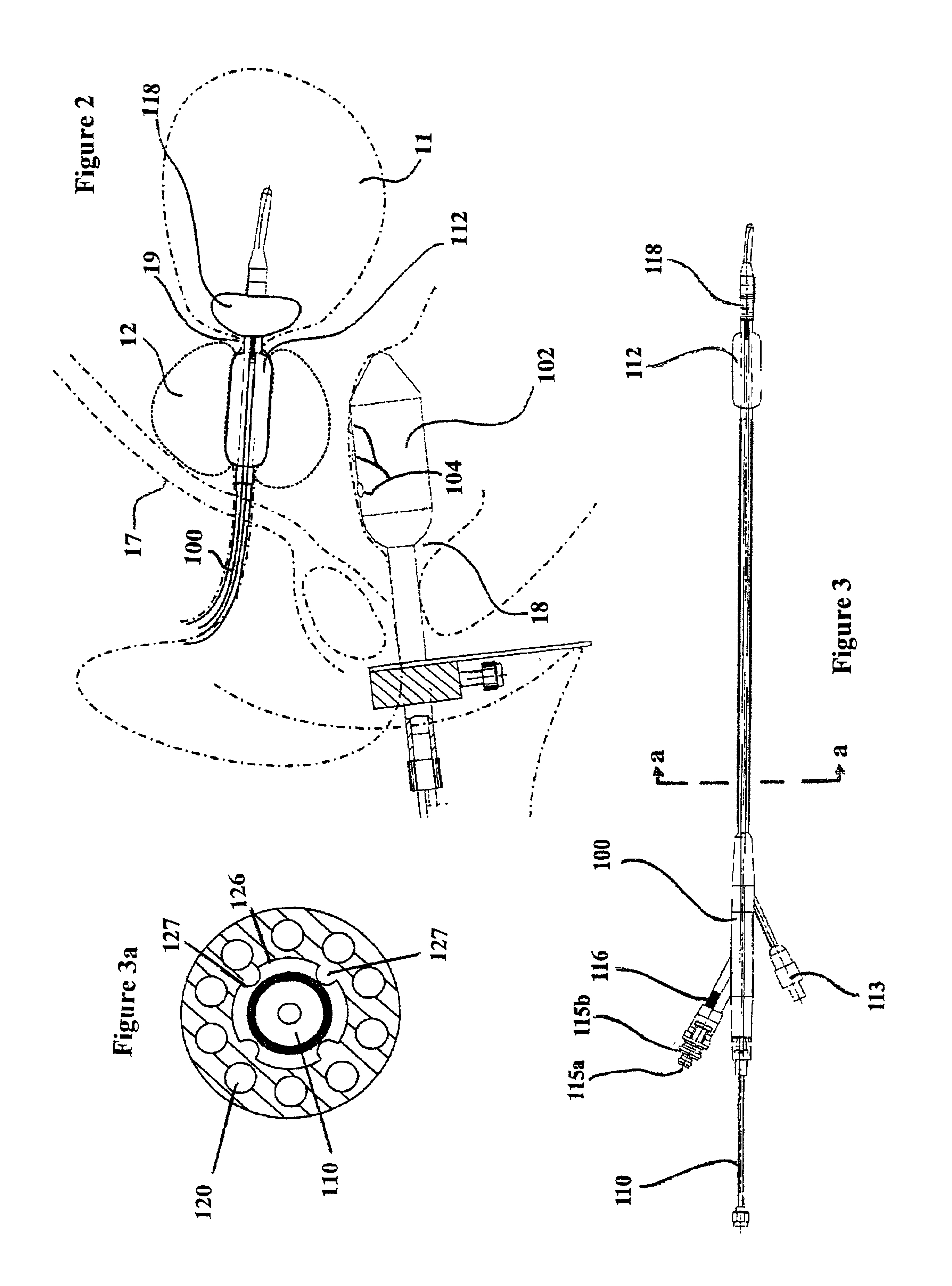 Device and method for treatment of tissue adjacent a bodily conduit by thermocompression