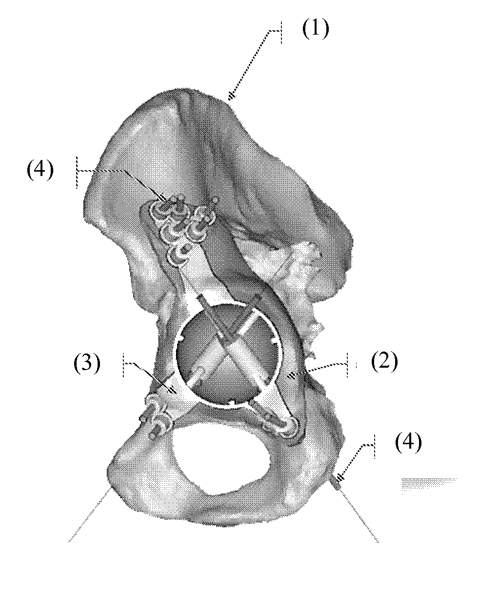 Customized surgical guides, methods for manufacturing and uses thereof