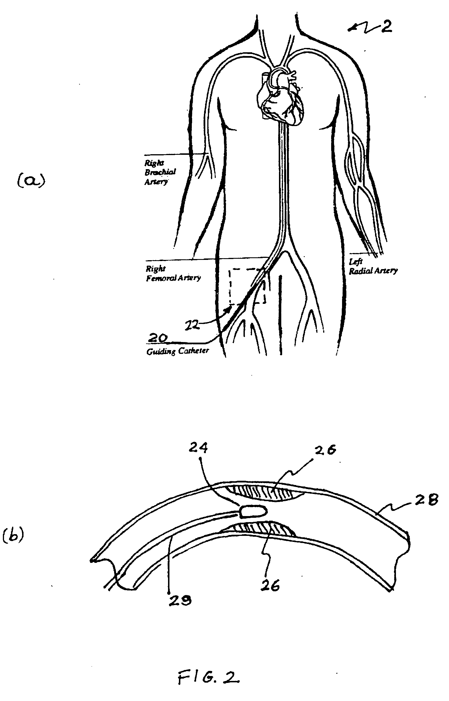 Radio-frequency device for passivation of vascular plaque and method of using same