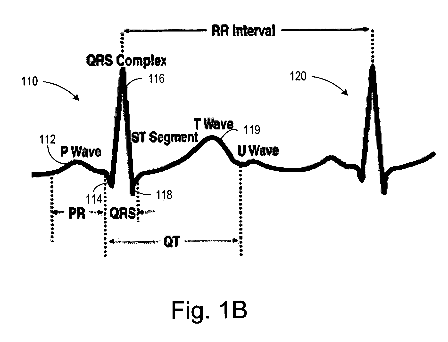 Arrhythmia discrimination using electrocardiograms sensed from multiple implanted electrodes