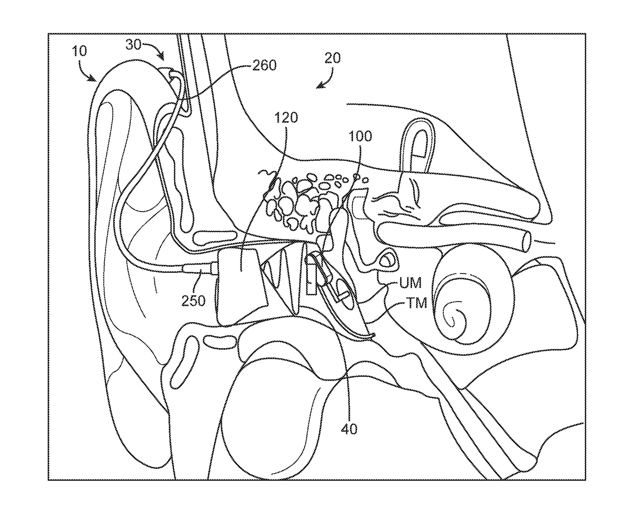 Battery coating for rechargable hearing systems