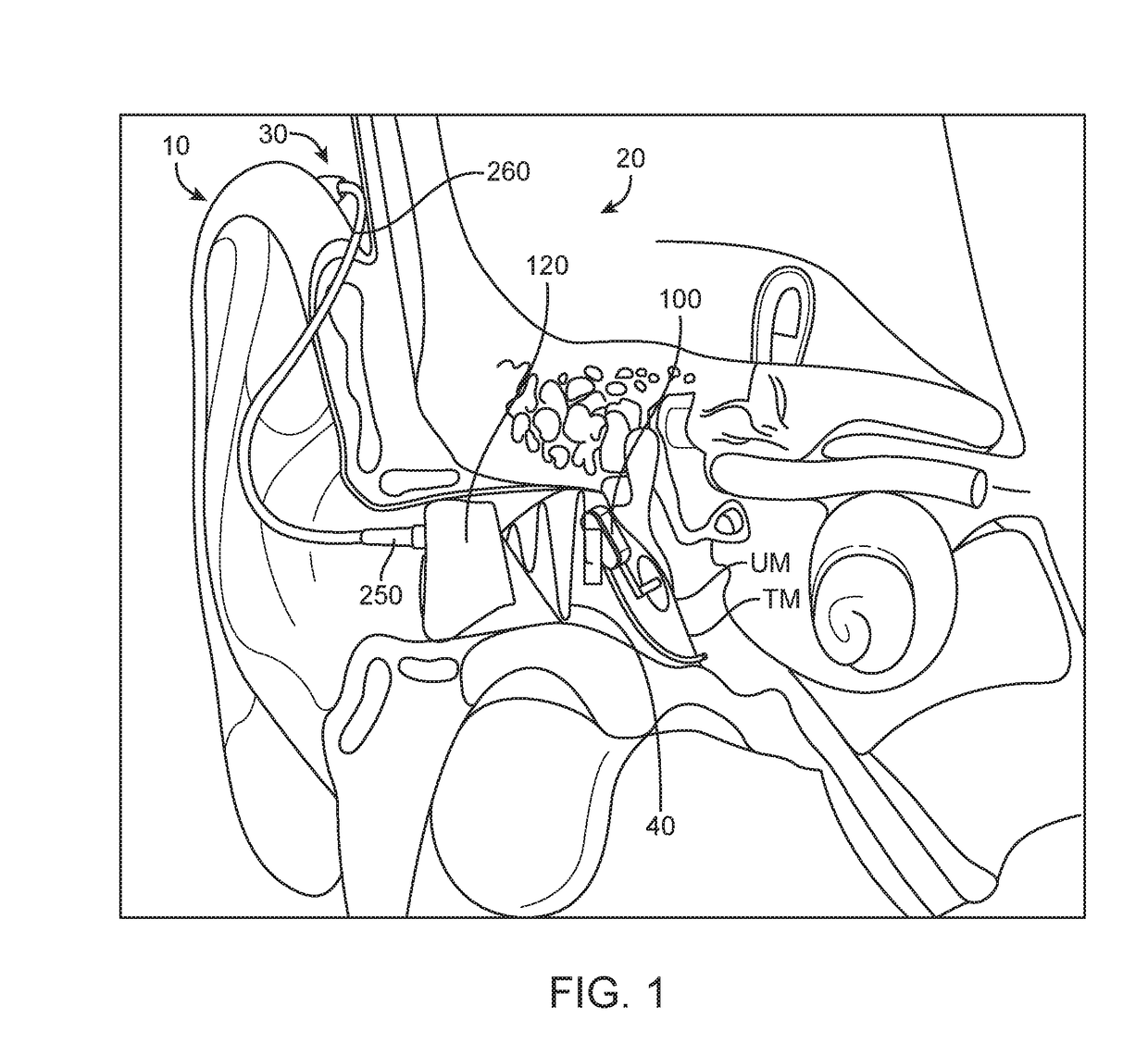 Battery coating for rechargable hearing systems