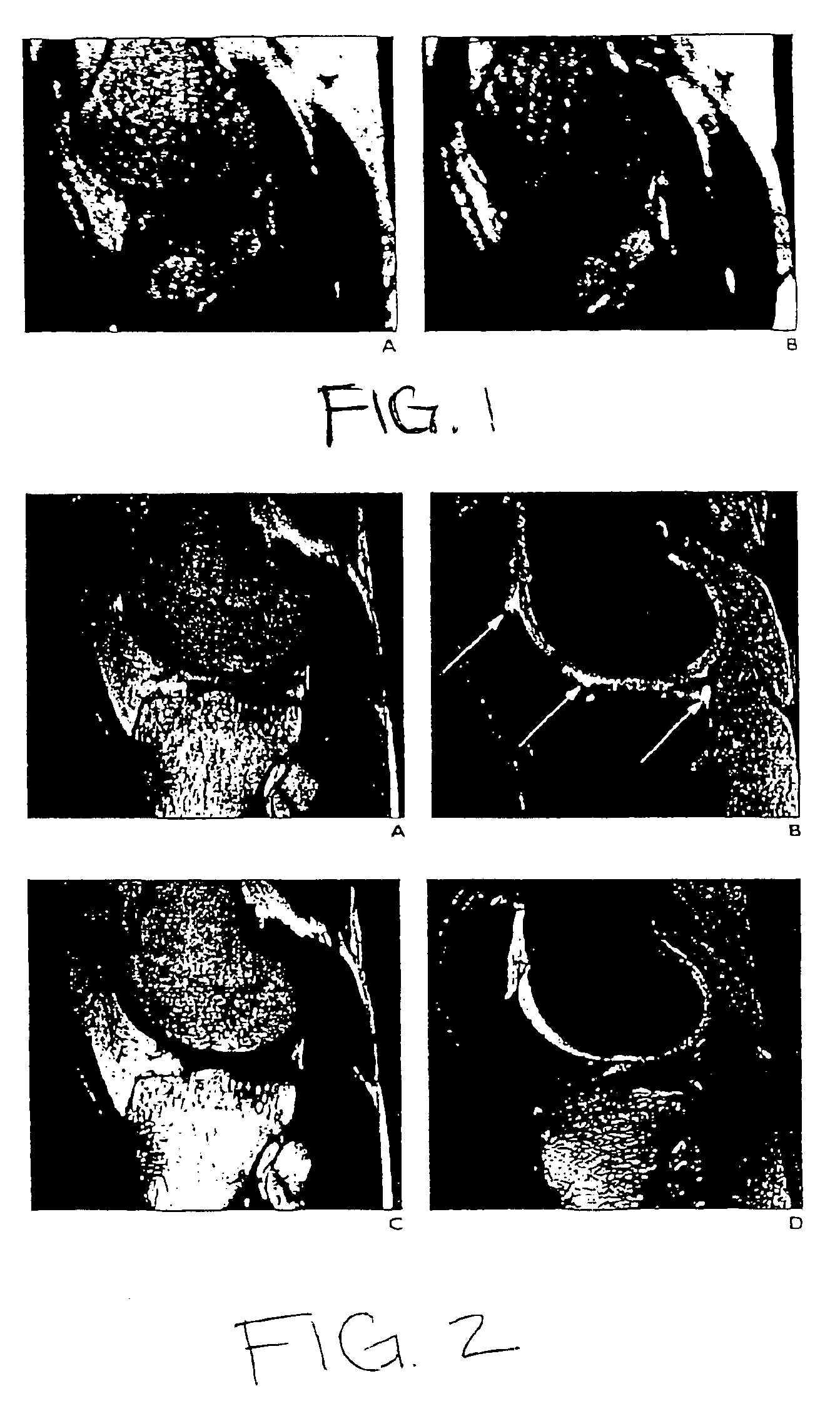 Magnetic resonance imaging with fat-water signal separation