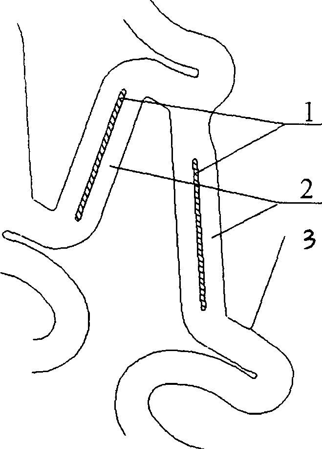 Vascular stent mounted with non penetrable slot or blind hole and its preparing method