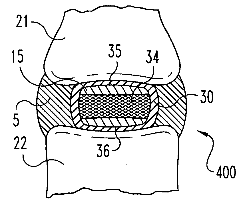 Methods for forming and retaining intervertebral disc implants