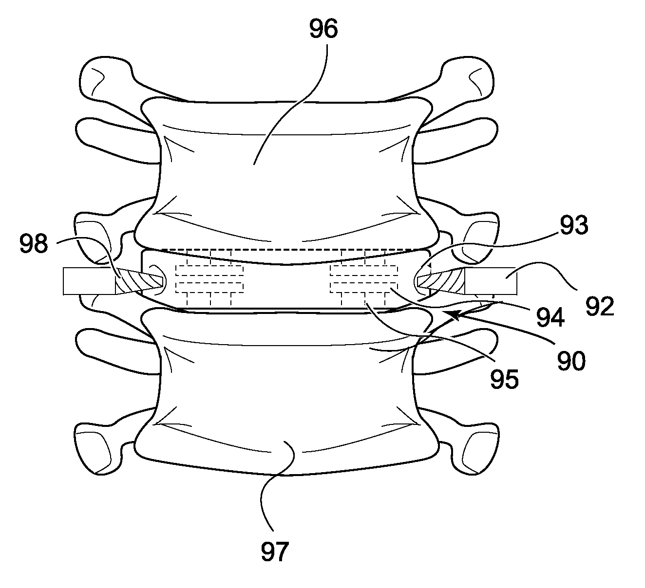 Device and method for orthopedic fracture fixation