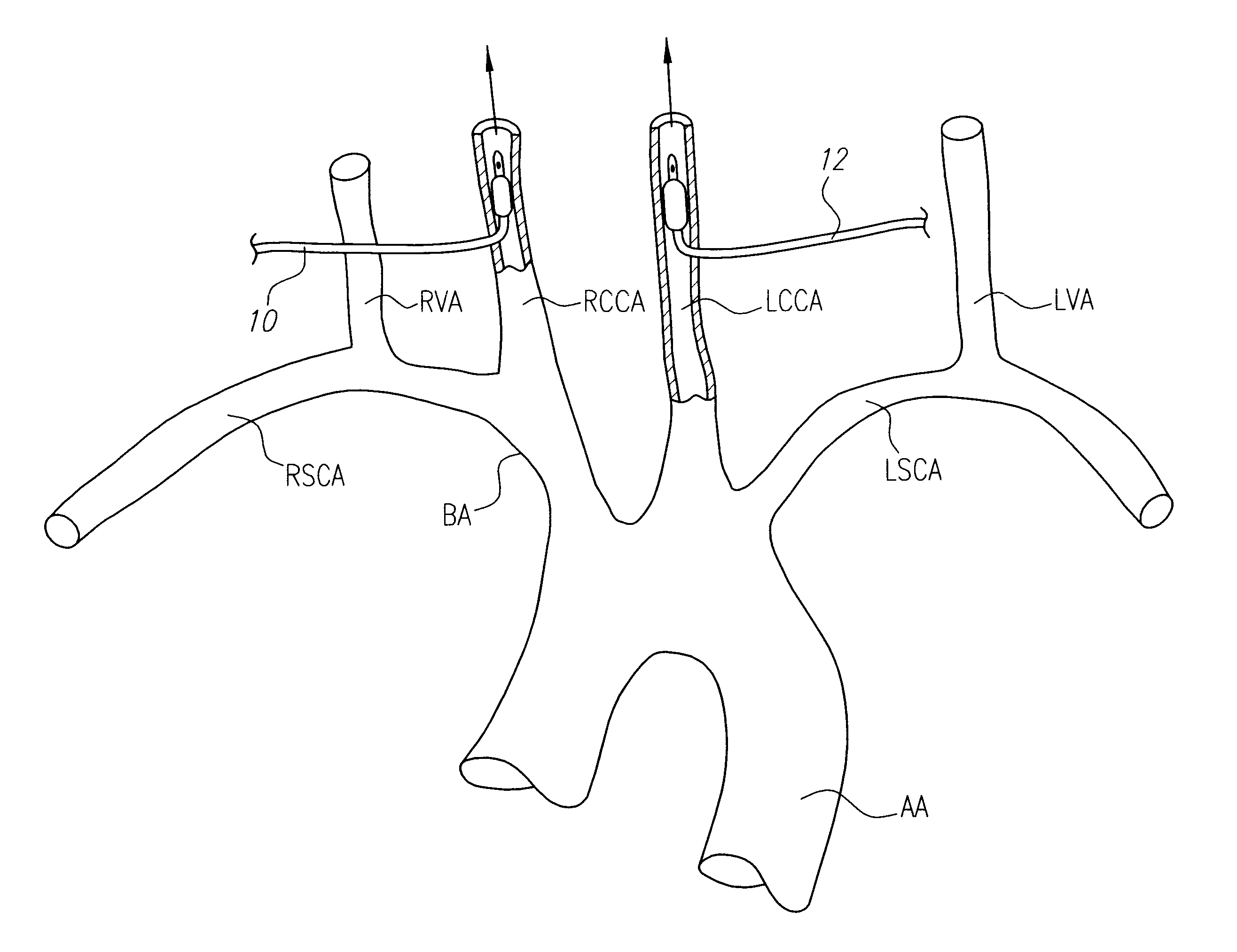 Intravascular methods and apparatus for isolation and selective cooling of the cerebral vasculature during surgical procedures