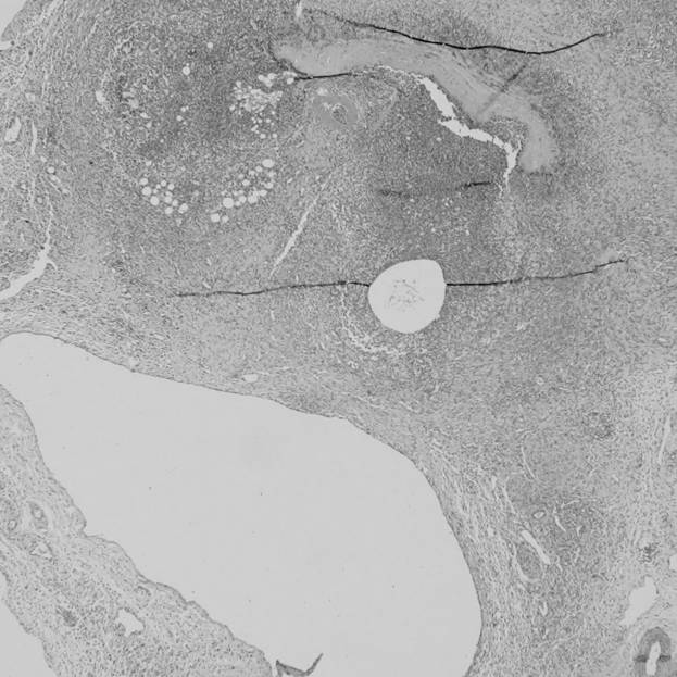 Preparation method and application of hyaluronic acid-heparin adhered great saphenous vein patch