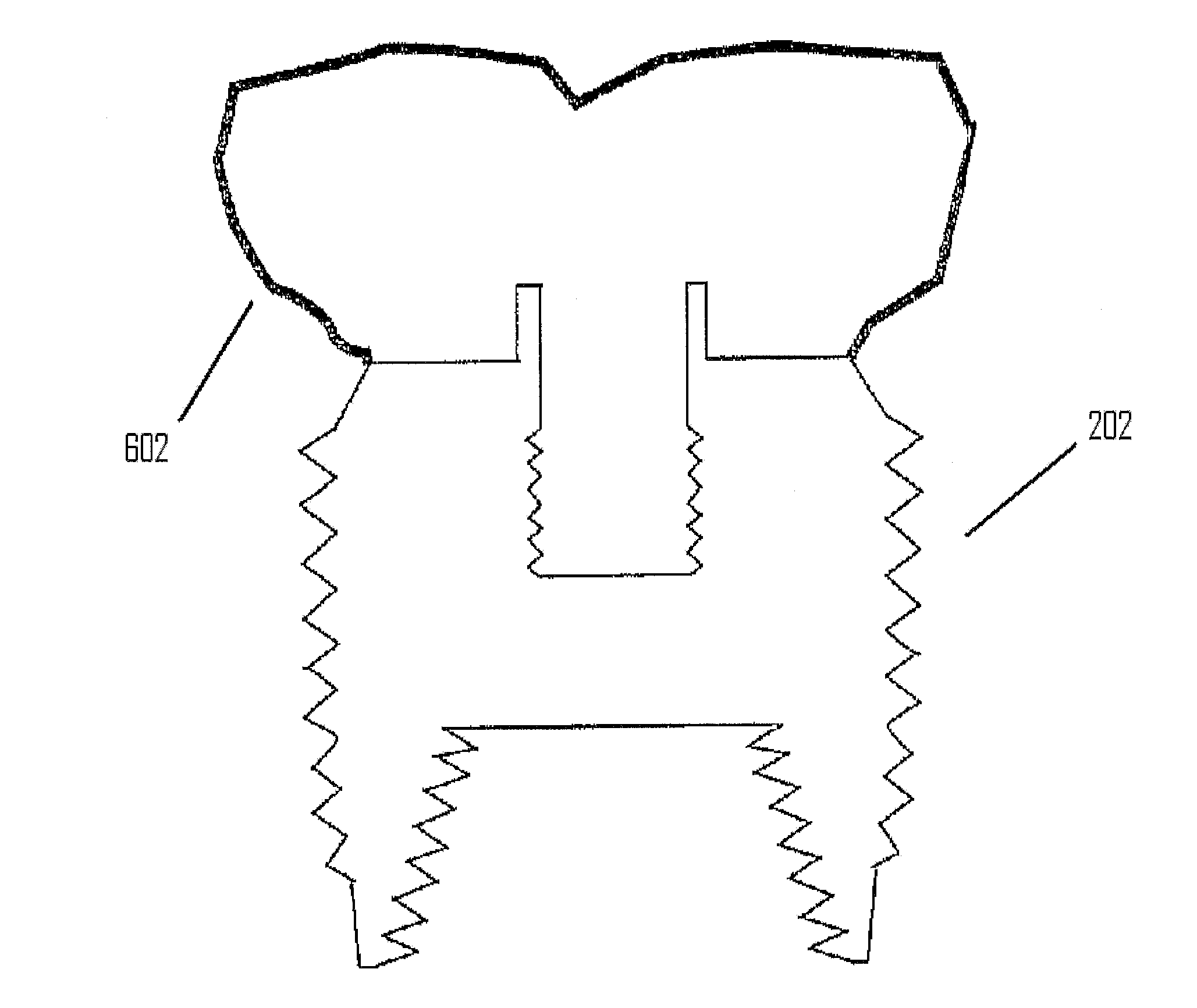 Apical cutting thread dental implant