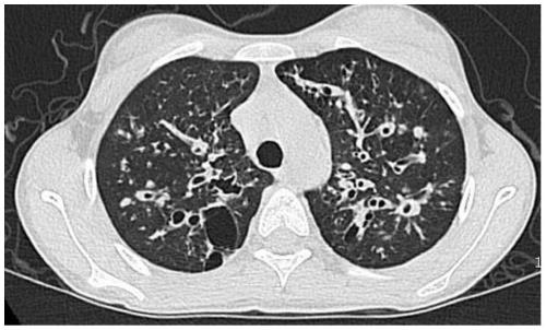 Mutated form of cftr gene in cystic fibrosis patients and its application