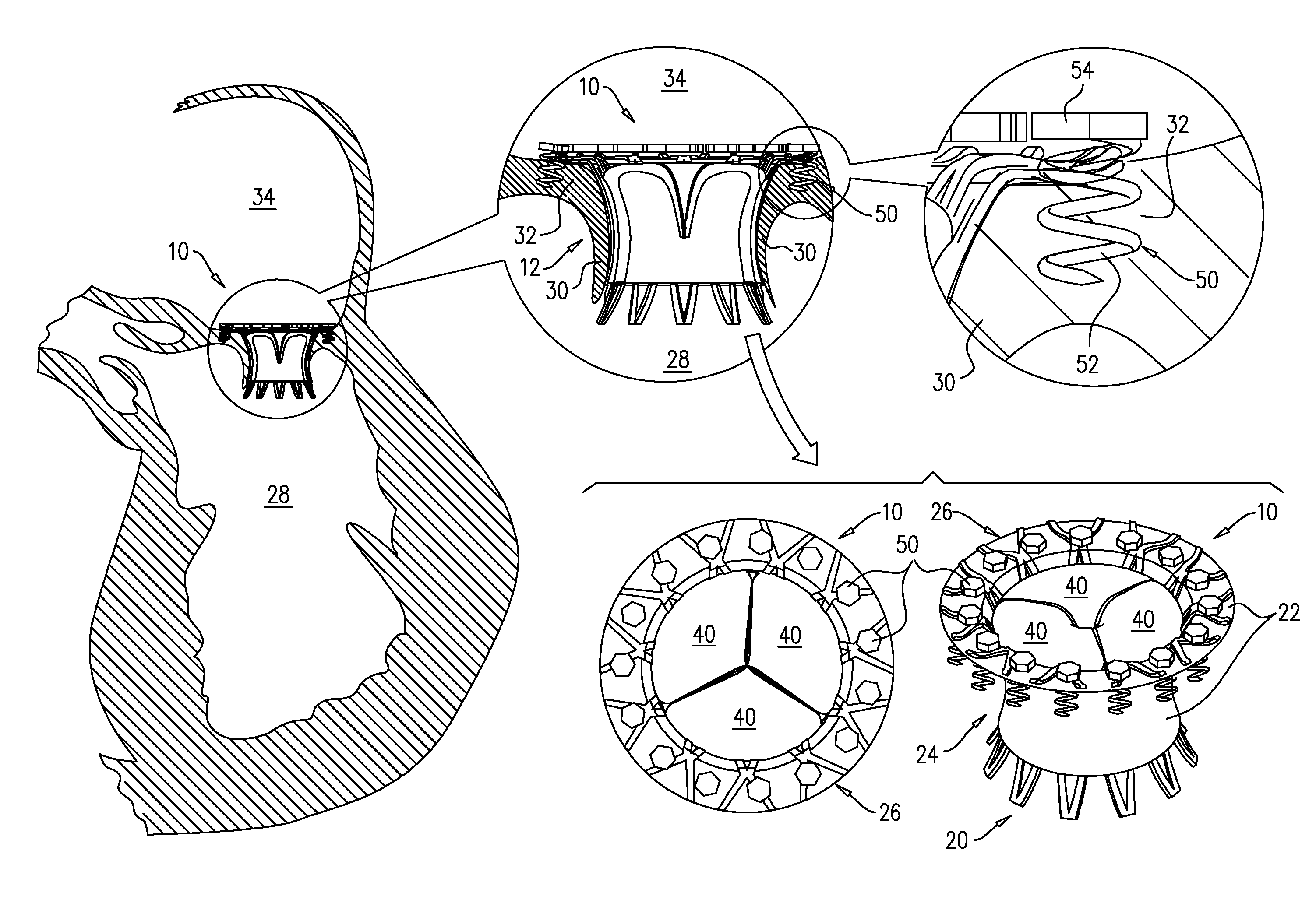 Axially-shortening prosthetic valve