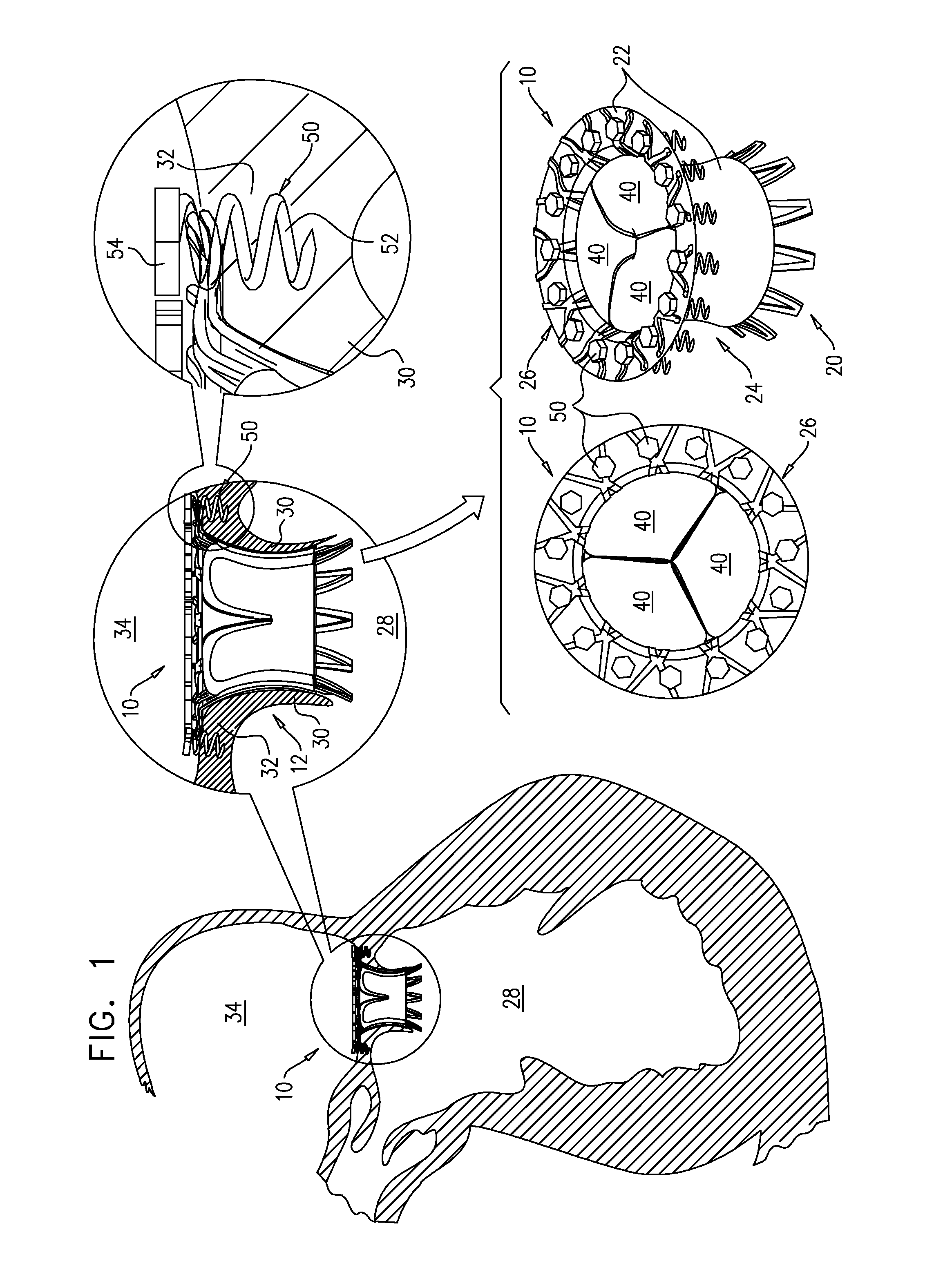 Axially-shortening prosthetic valve