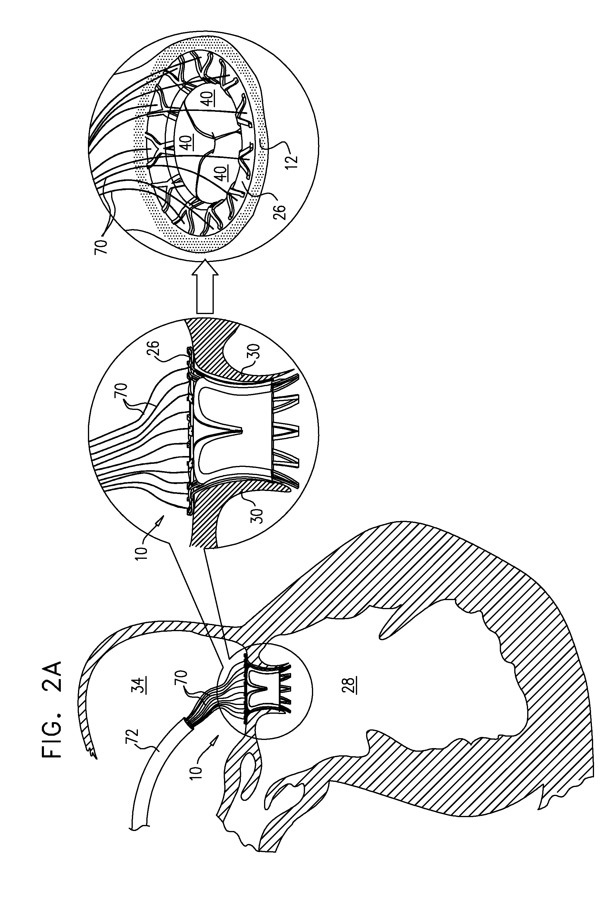 Axially-shortening prosthetic valve