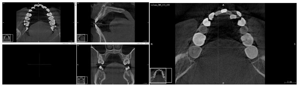 Dental CBCT three-dimensional tooth segmentation method based on deep learning