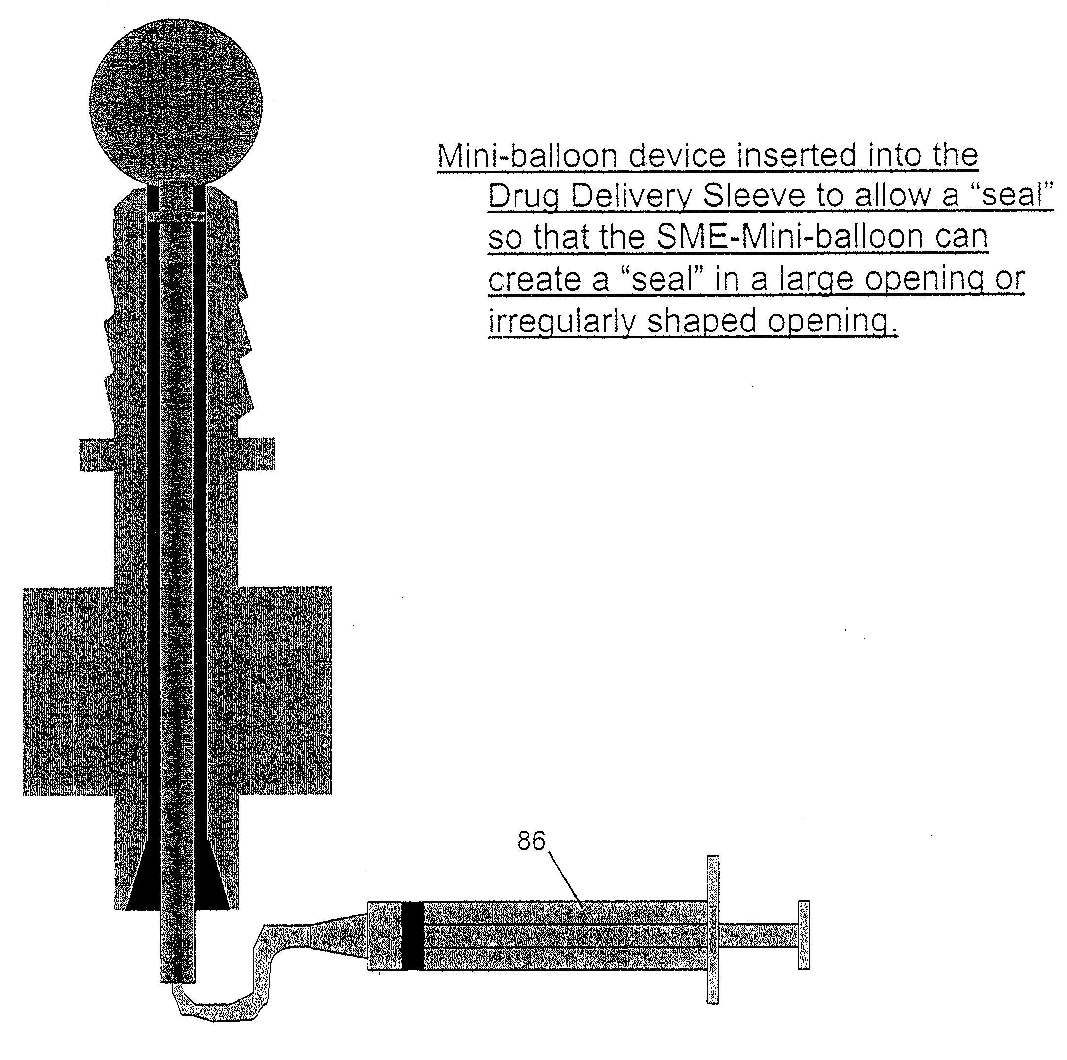 Method and apparatus for performing maxillary sinus elevation