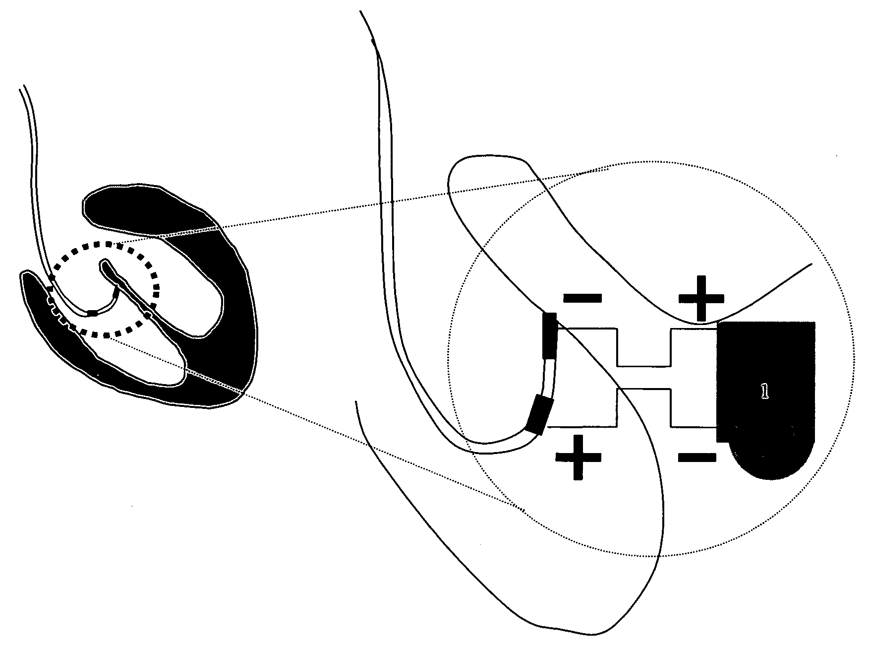 Pacemaker which reestablishes or keeps the physiological electric conduction of the heart and a method of application