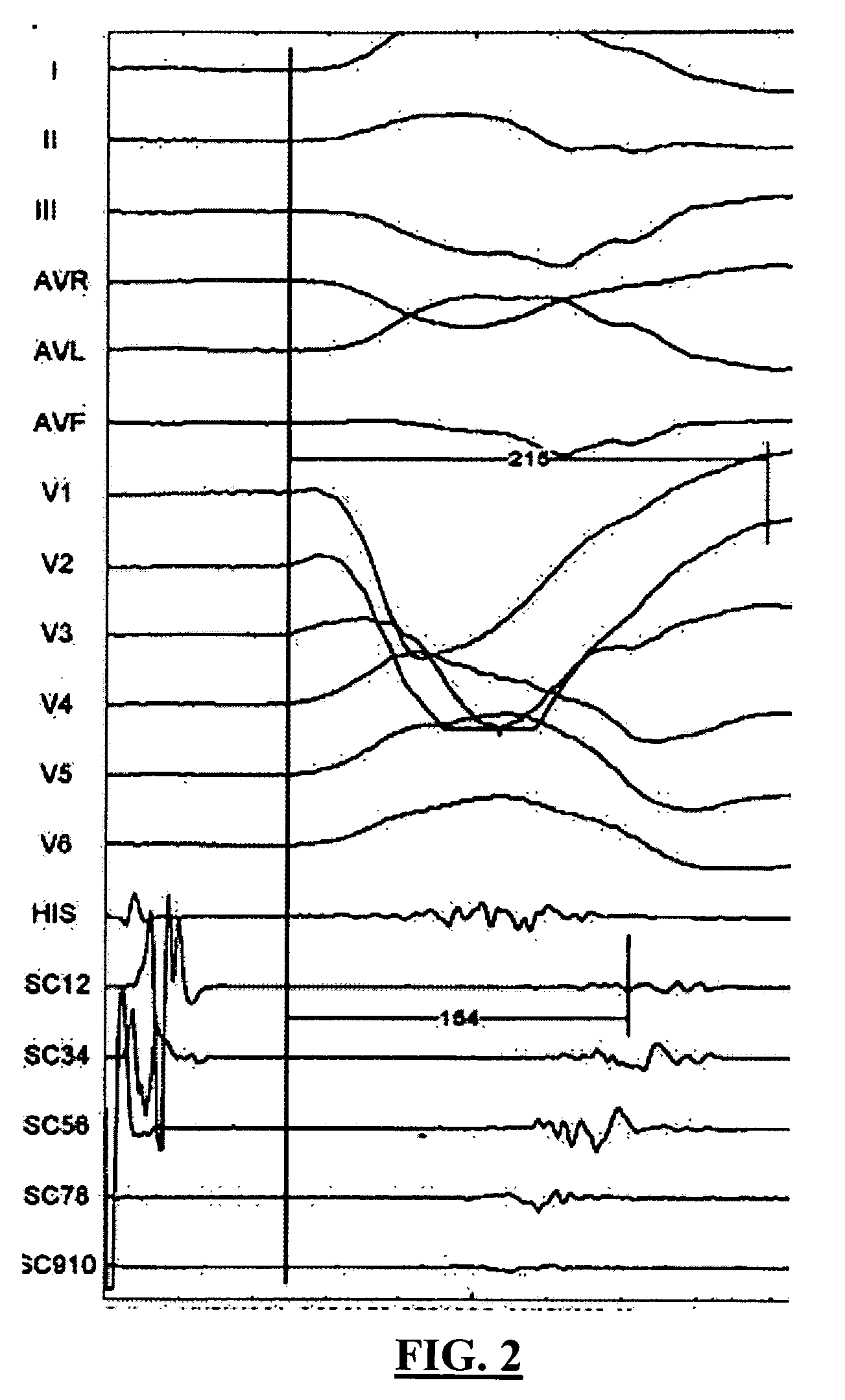 Pacemaker which reestablishes or keeps the physiological electric conduction of the heart and a method of application