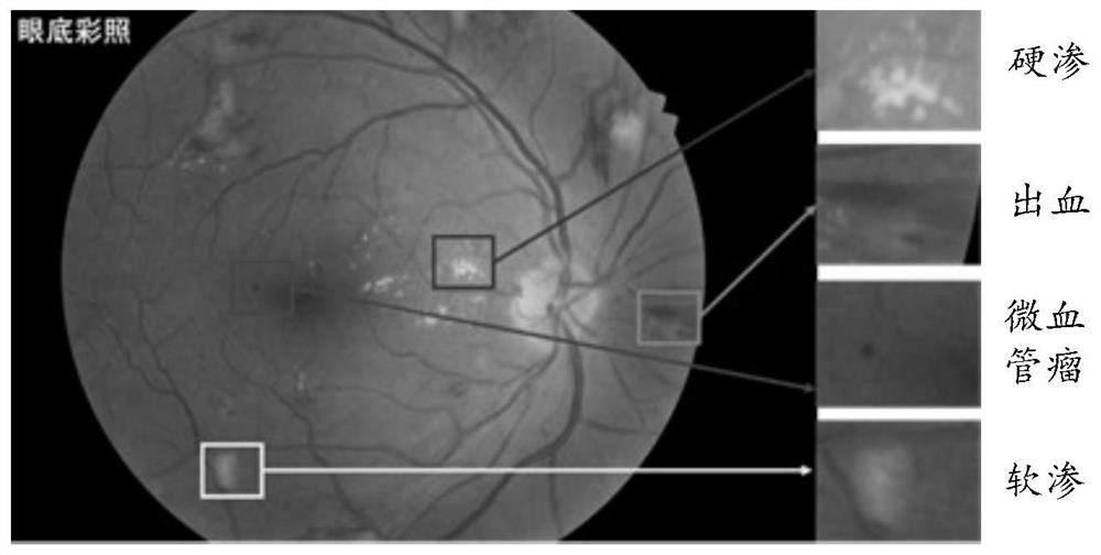 Eye fundus image recognition method and device, equipment, storage medium and program product