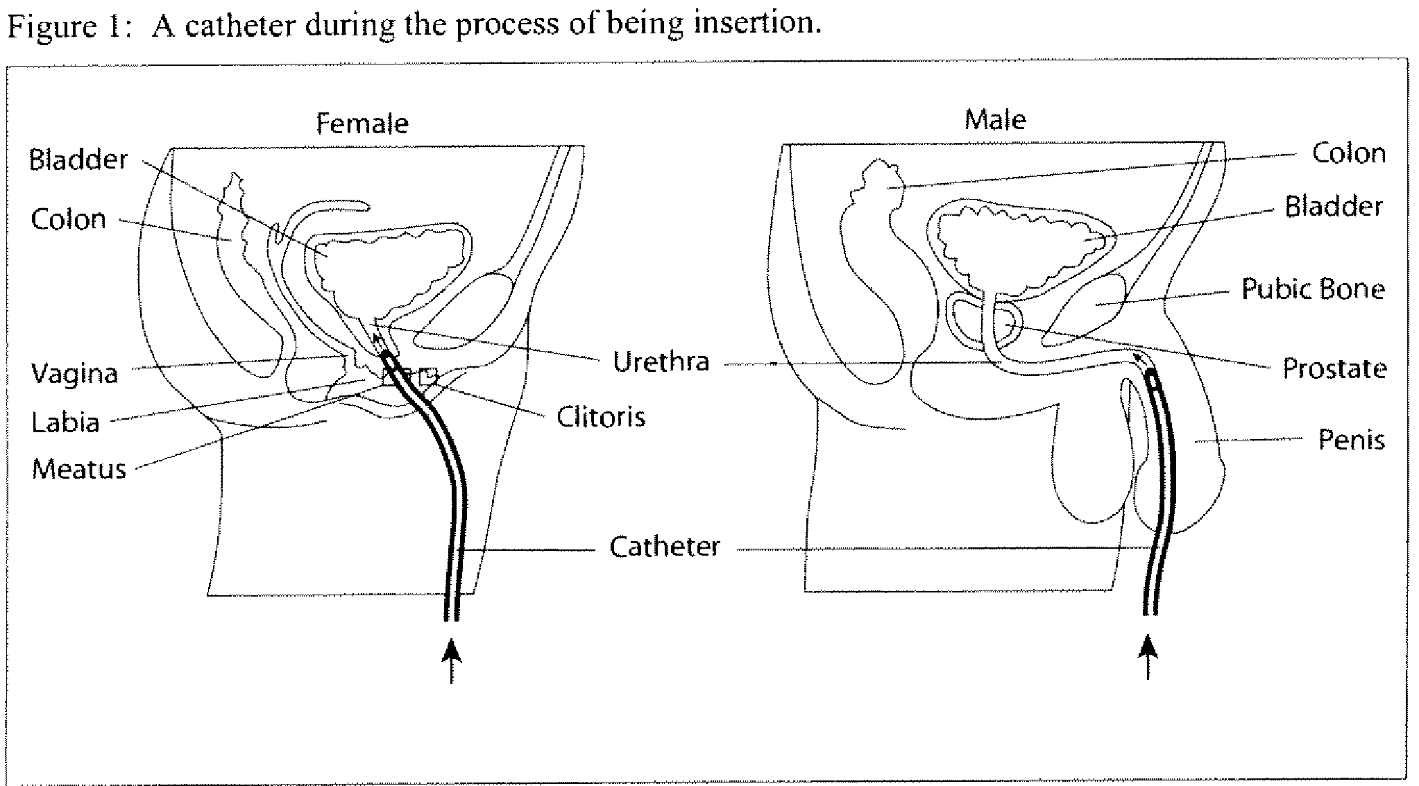 System and method for the prevention and treatment of bacterial and fungal infections including urinary tract infections (UTI) using a hypohalous acid composition