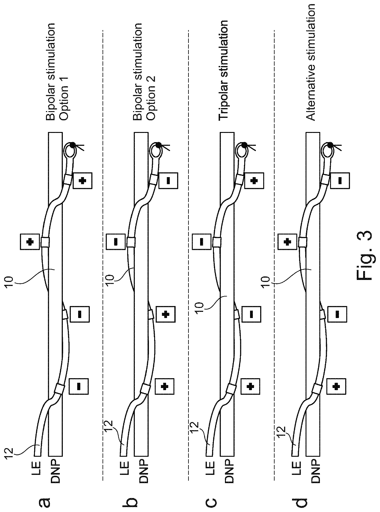 Implantable neurostimulator and methods for implanting and using same