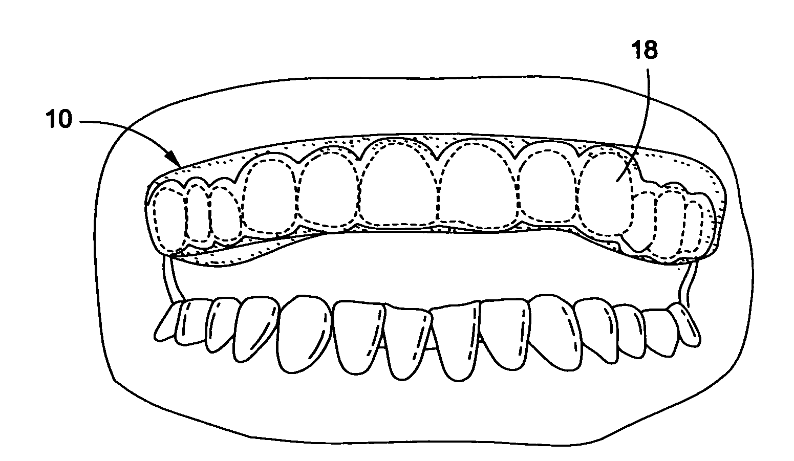 Dental appliance, oral care product and method of preventing dental disease