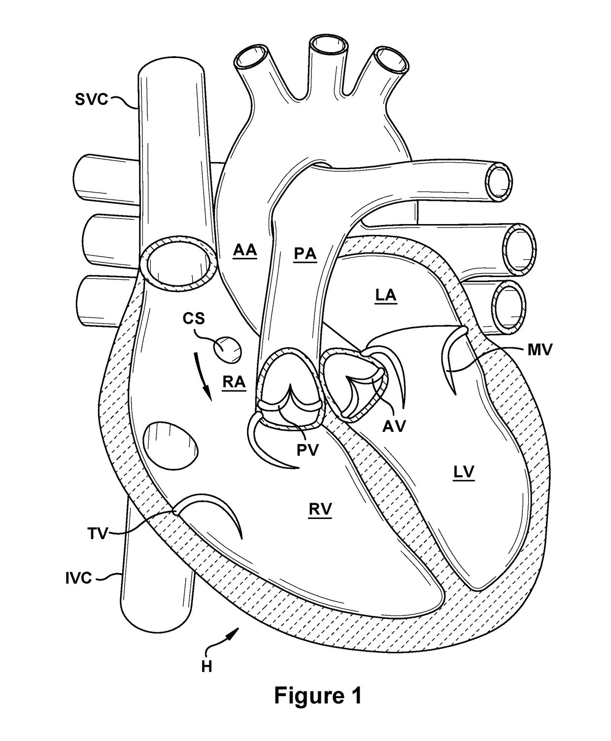 Native valve repair devices and procedures