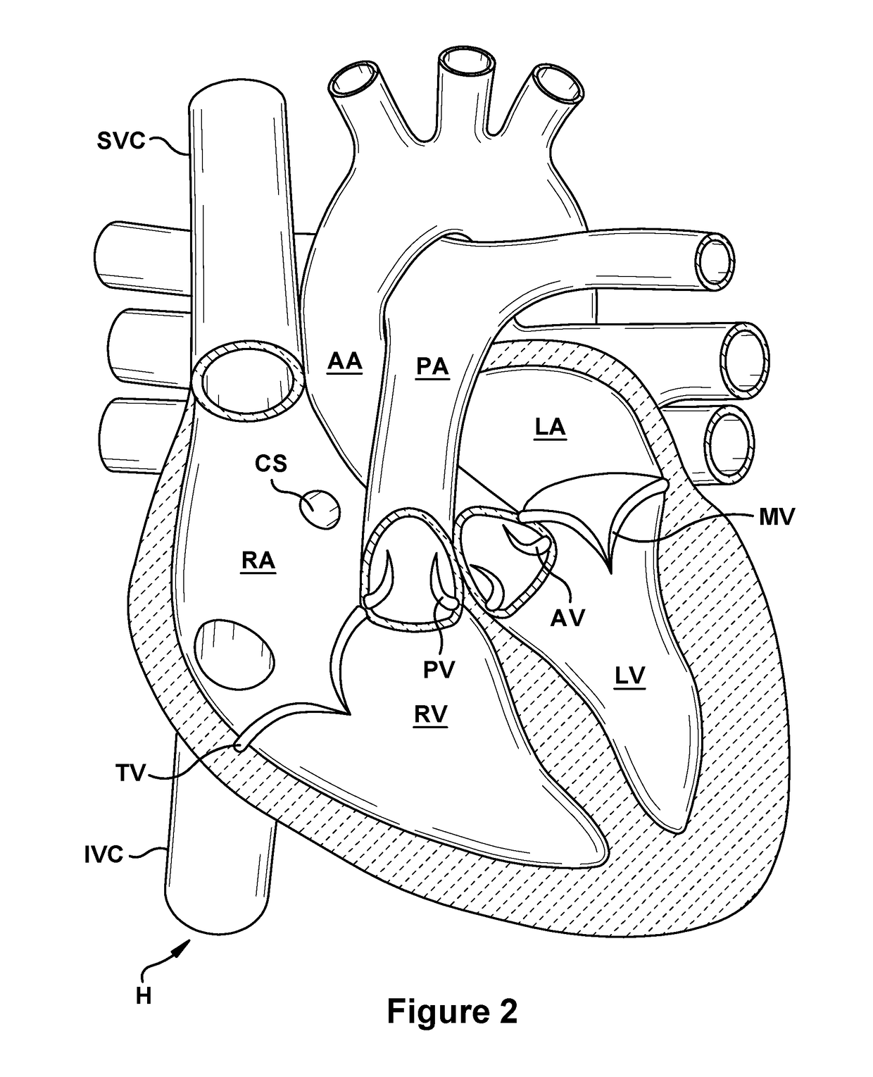 Native valve repair devices and procedures