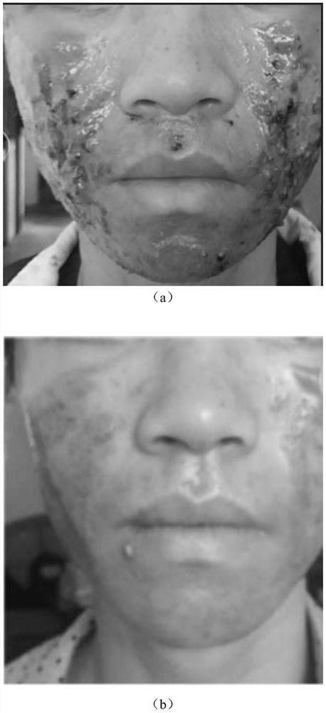 Ozone liquid dressing applied to skin diseases and preparation method thereof