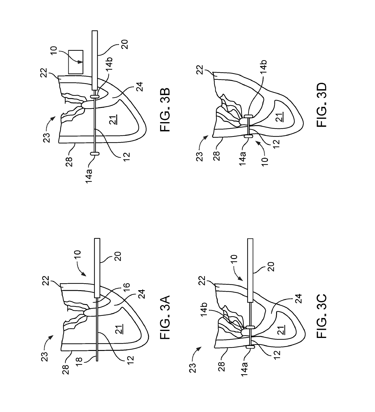 Right ventricular papillary approximation