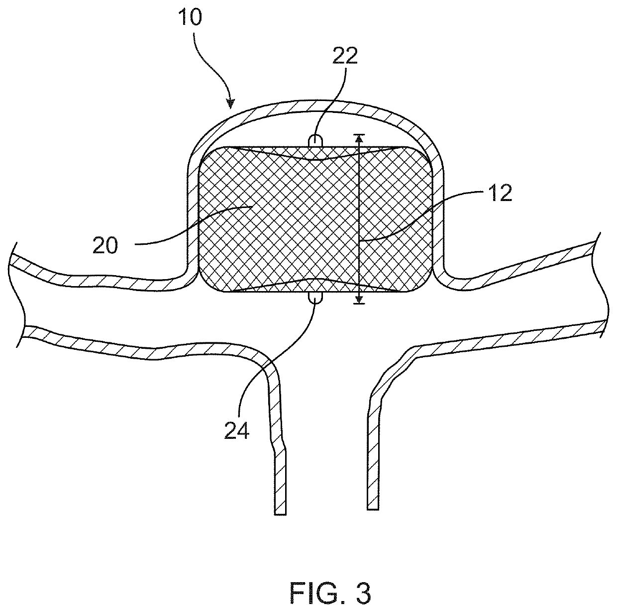 Medical Devices With Sensing Characteristics For Intravascular Treatment Sites And Methods Thereof